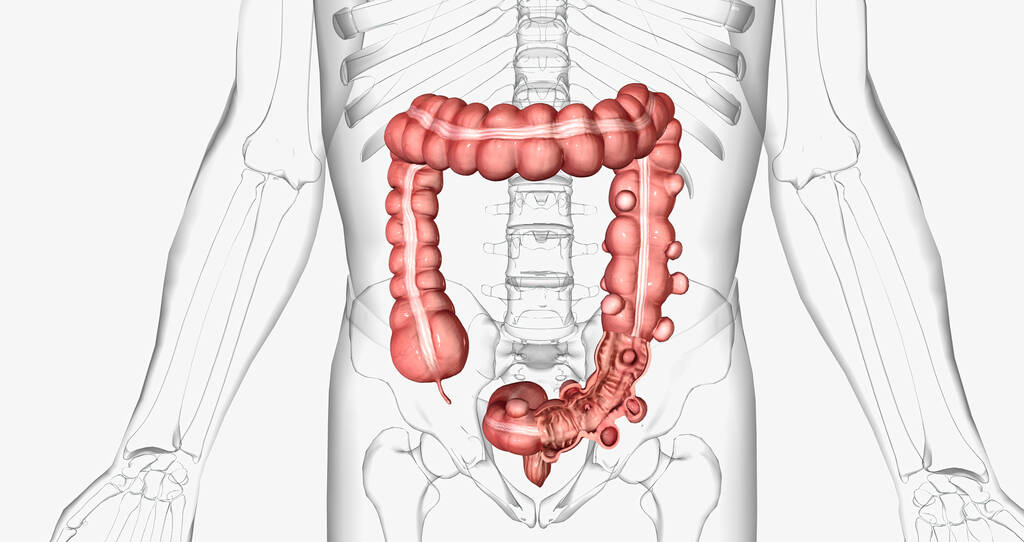 Diverticolite e glicemia