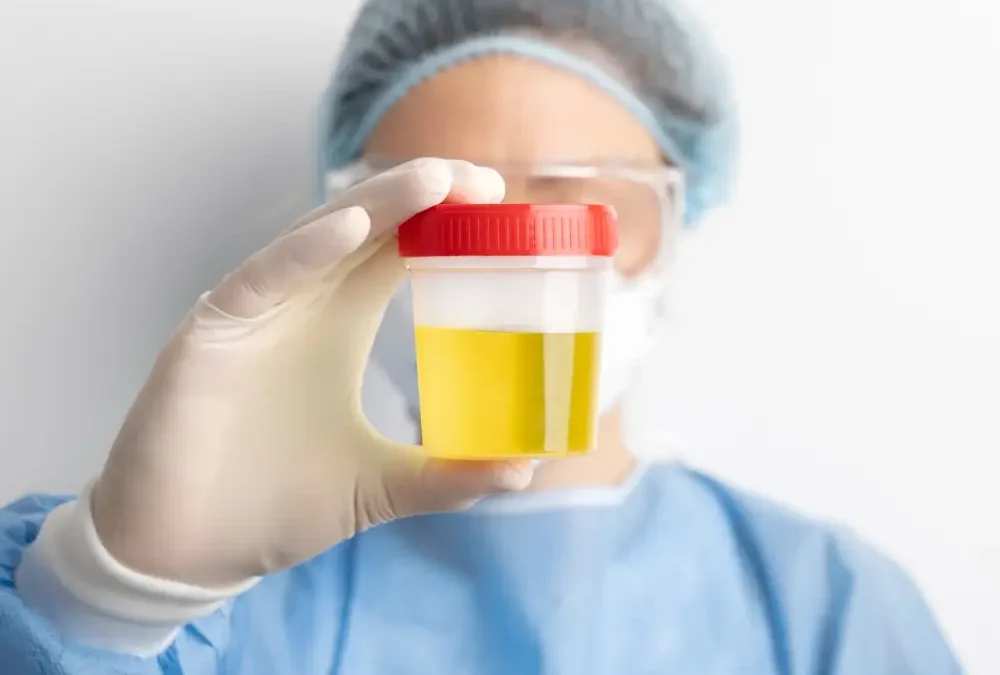 Zucchero nelle urine Glicosuria