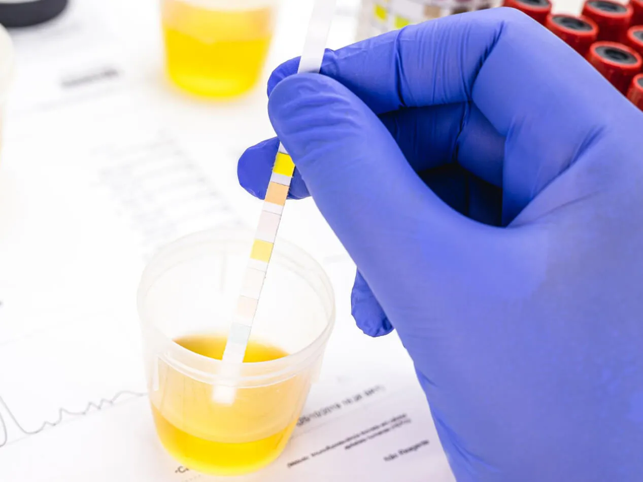 Chetone nelle urine Chetone nelle urine