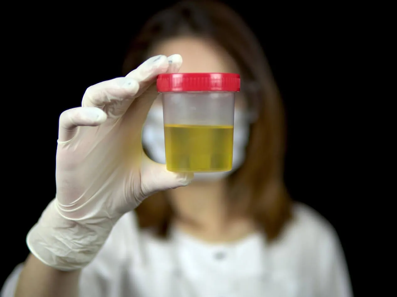 Diabete renale glucosio nelle urine Diabete renale glucosio nelle urine