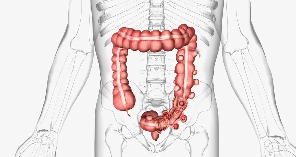 Diverticolite e glicemia